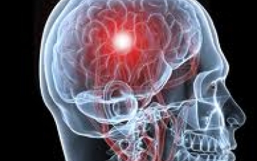 Veszélyesebb a látáskieséssel járó TIA