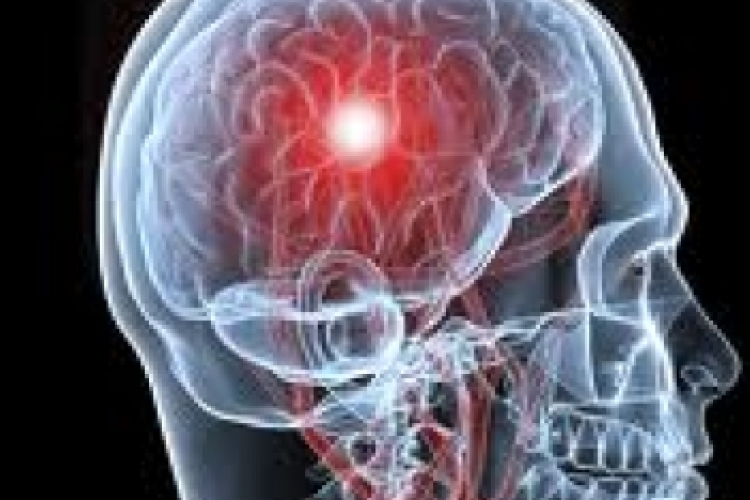 Veszélyesebb a látáskieséssel járó TIA