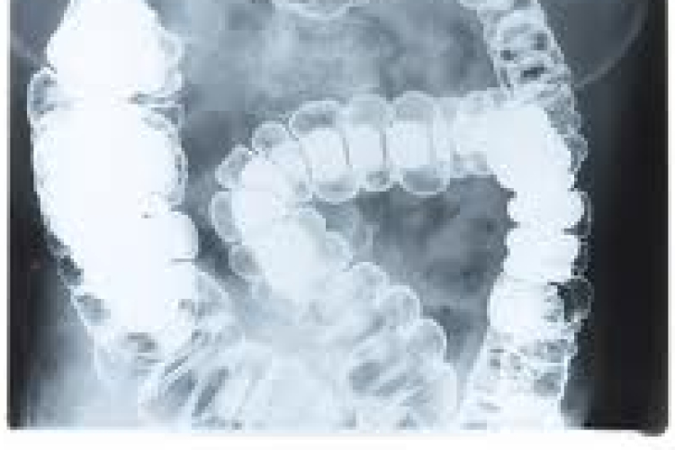 Új kezelés segíthet a Chron-betegségben szenvedőkön