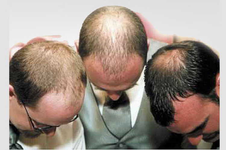 Klónozás vet véget a kopaszodásnak?