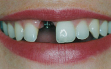 Sokan nem tudják, hogy a fogmegtartó kezelések mai napig ingyenesek