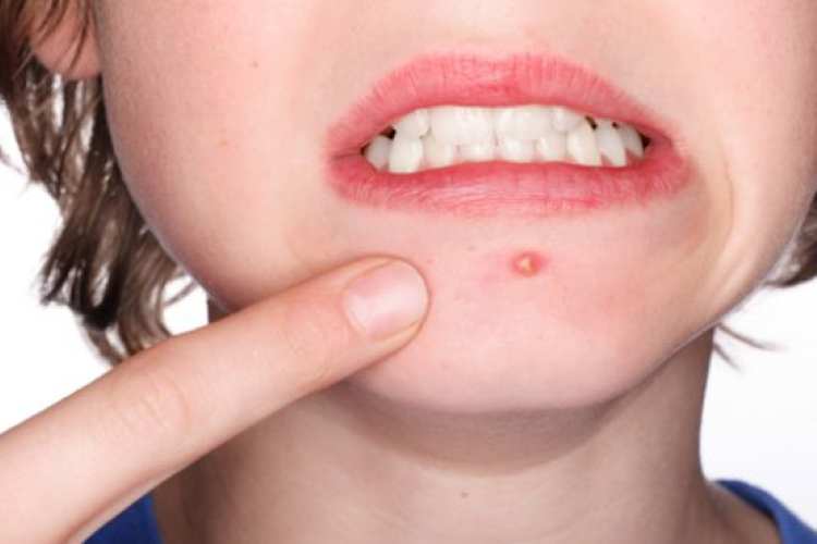 Mi okozza a pattanásokat? 